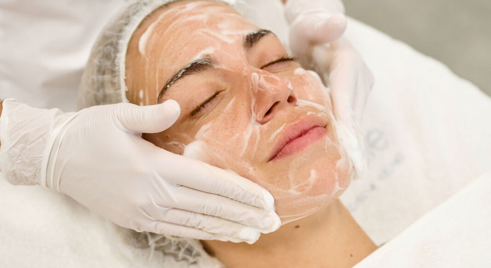 Waar Kan Rosacea Voorkomen