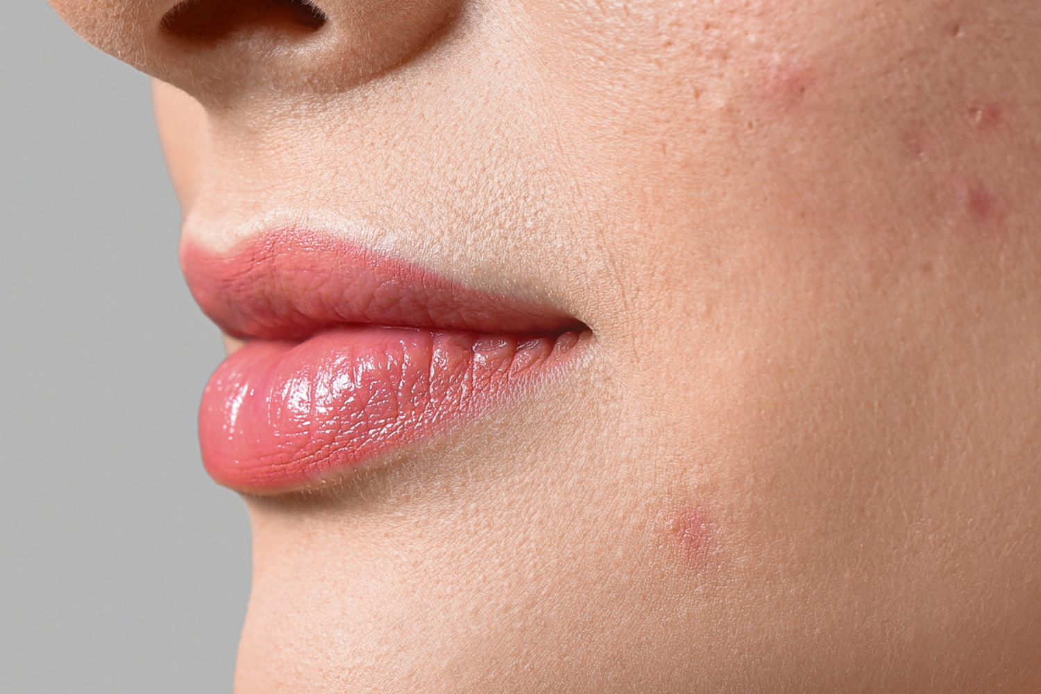SOIN ANTI ACNE