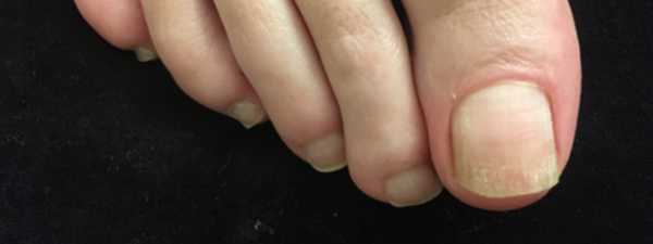 Traitement Mycose De L'ongle 32