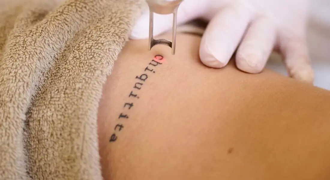 Tattoo Verwijderen Rosmalen
