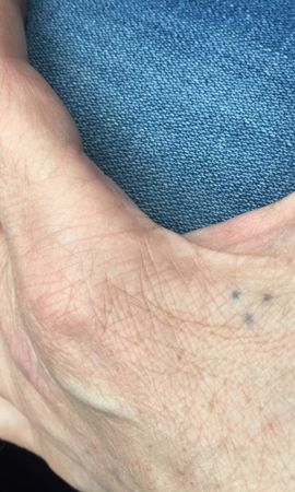 Tattoo Laseren Voor