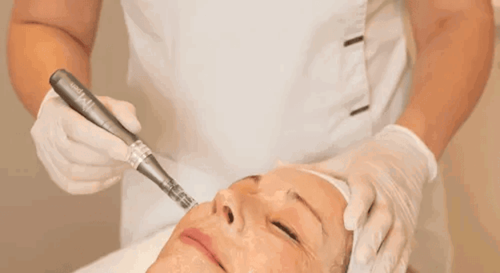 Medical Microneedling Frankfurt (2)
