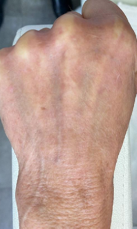 Taches Pigmentaires Mains 22