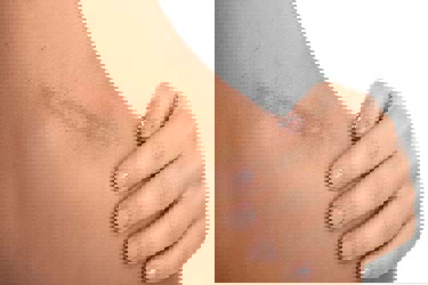 QU'est CE QU'une CICATRICE