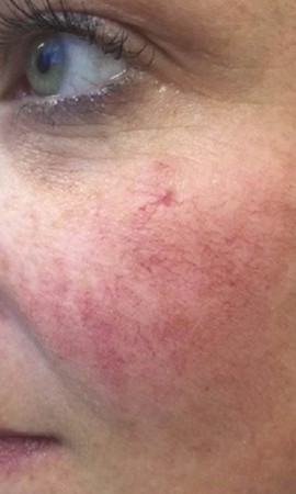 couperose behandelen resultaat