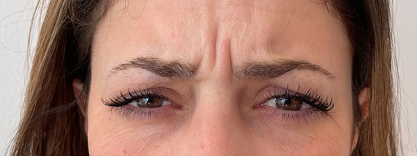Botox Frons 5