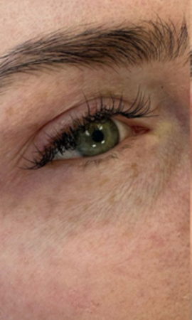 Colorescience Oogbehandeling Resultaat 1