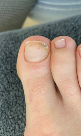 Traitement Mycose De L'ongle 52