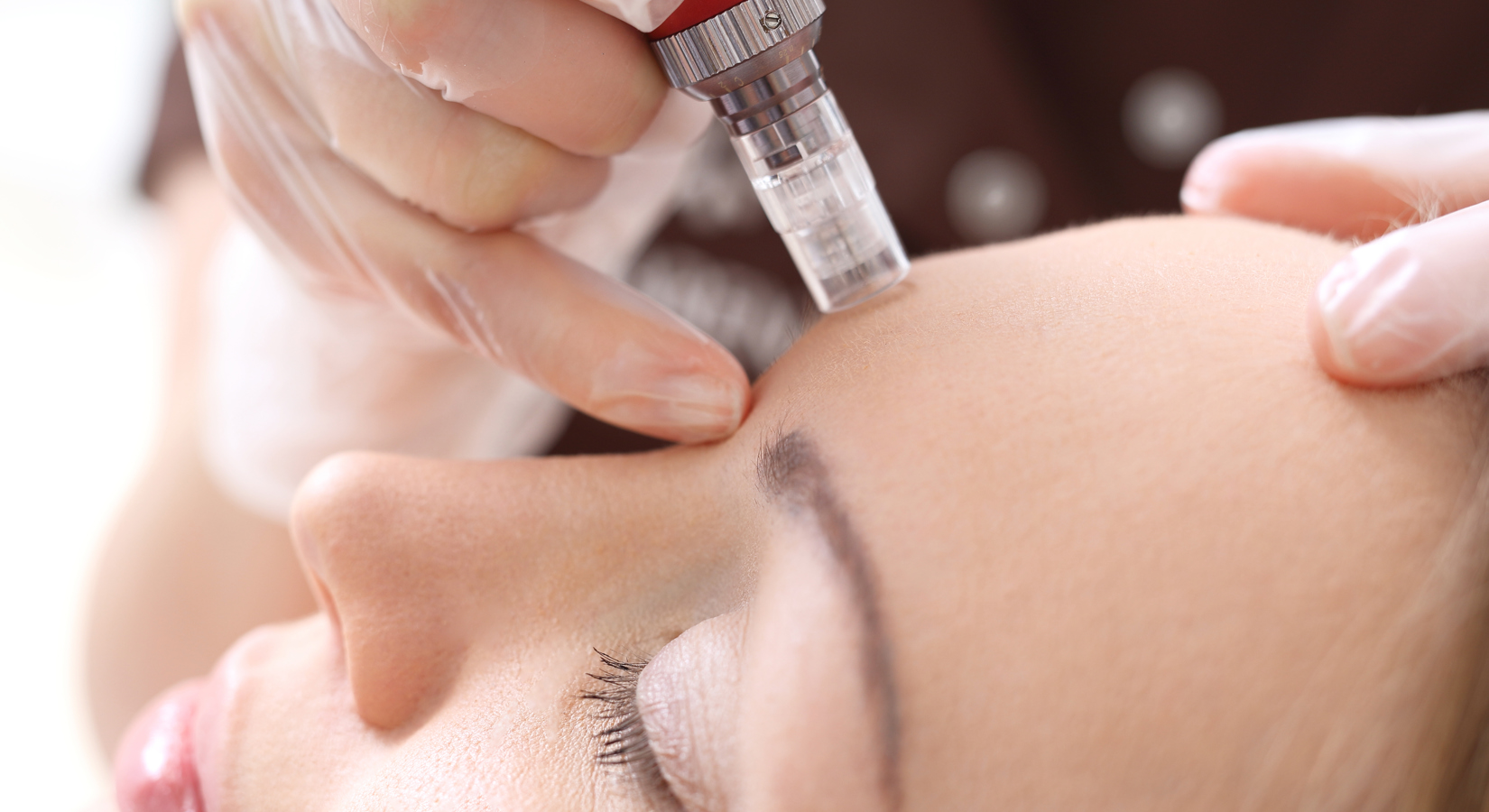 Microneedling (2)