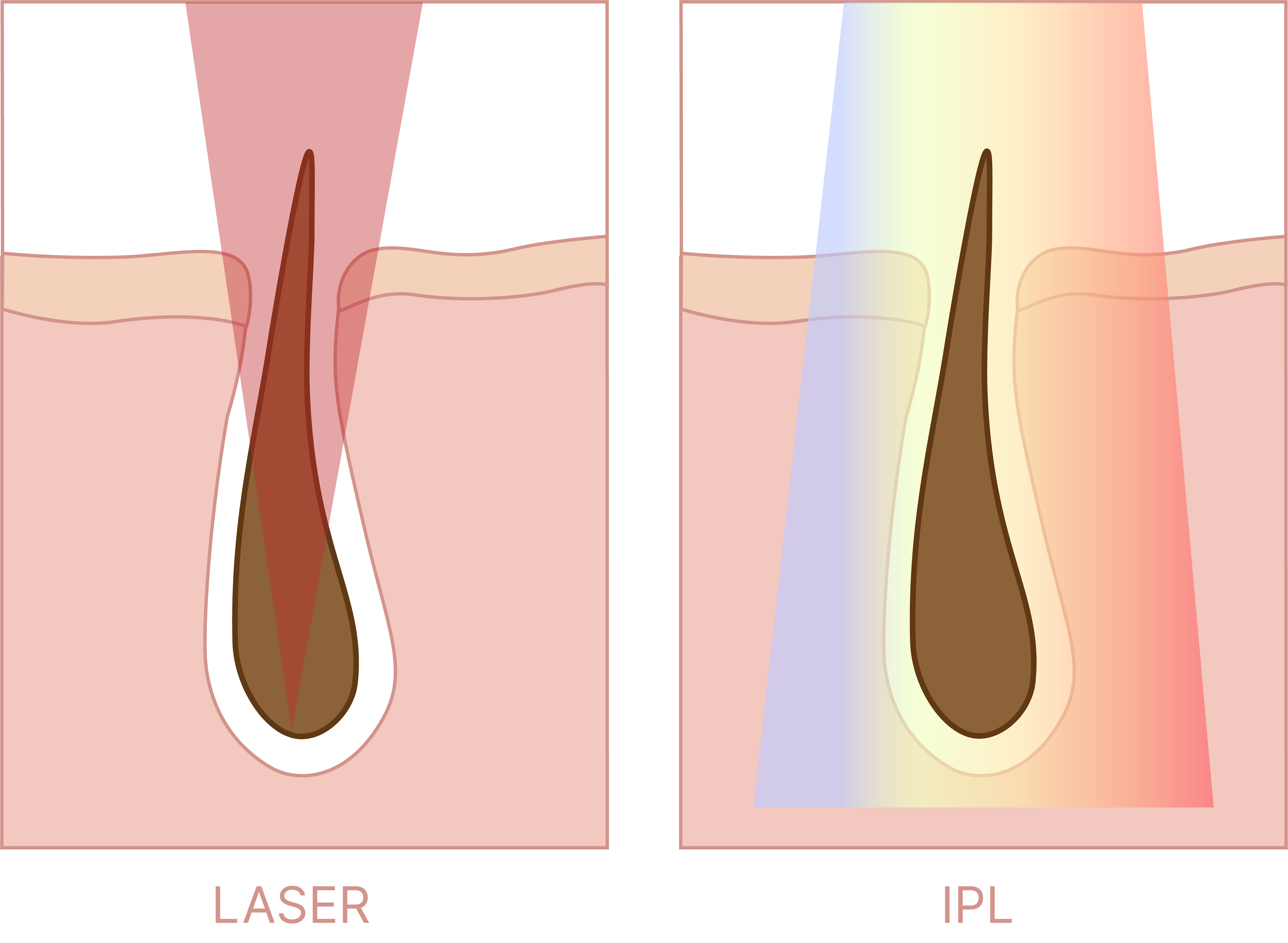 Épilation Au Laser Our IPL
