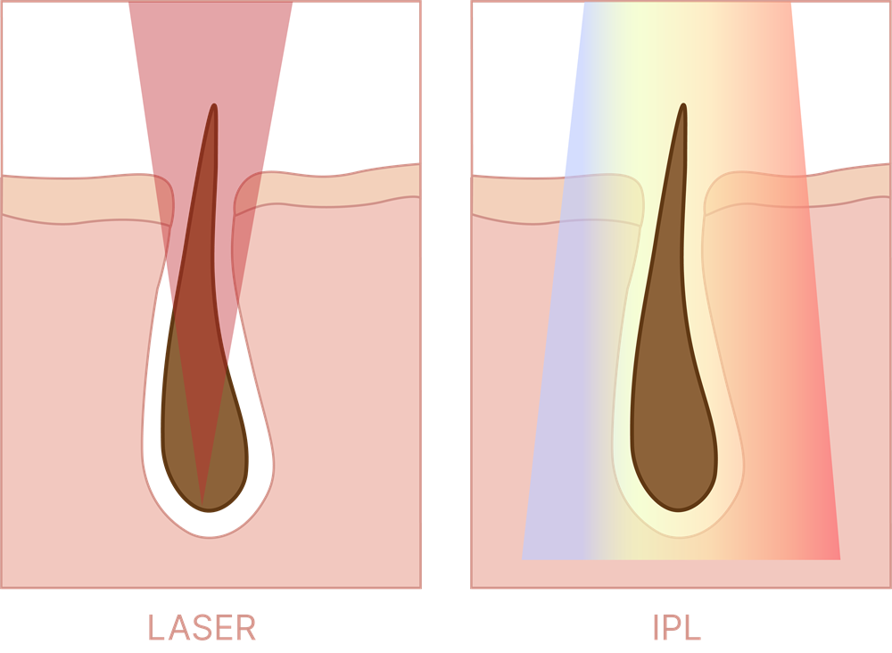 Épilation Au Laser Our IPL