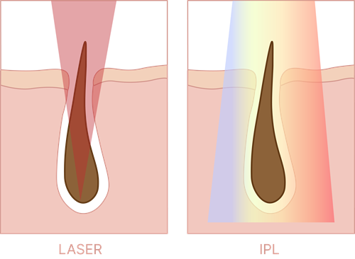 Épilation Au Laser Our IPL