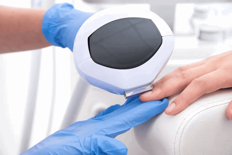 Traitement Au Laser Des Ongles Atteints De Mycose