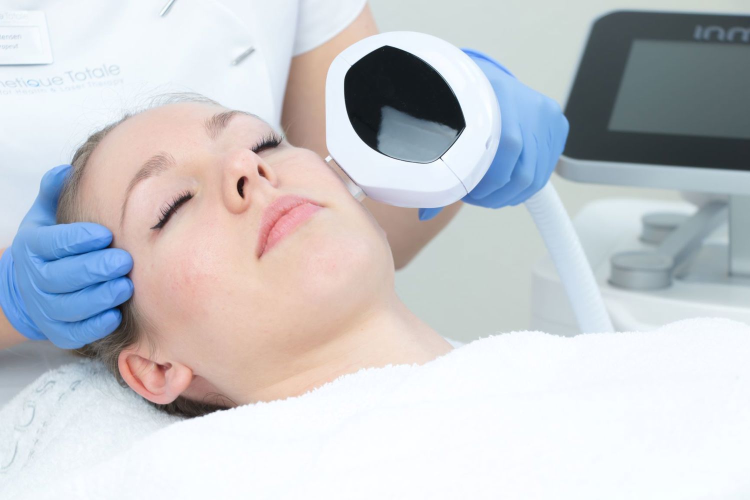 Couperose Behandeling Laser