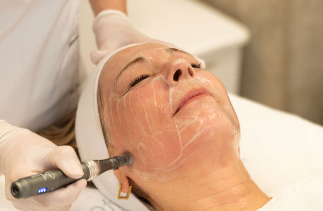 Microneedling behandeling van het gezicht door een huidtherapeut bij Cosmetique Totale in Alphen aan den Rijn