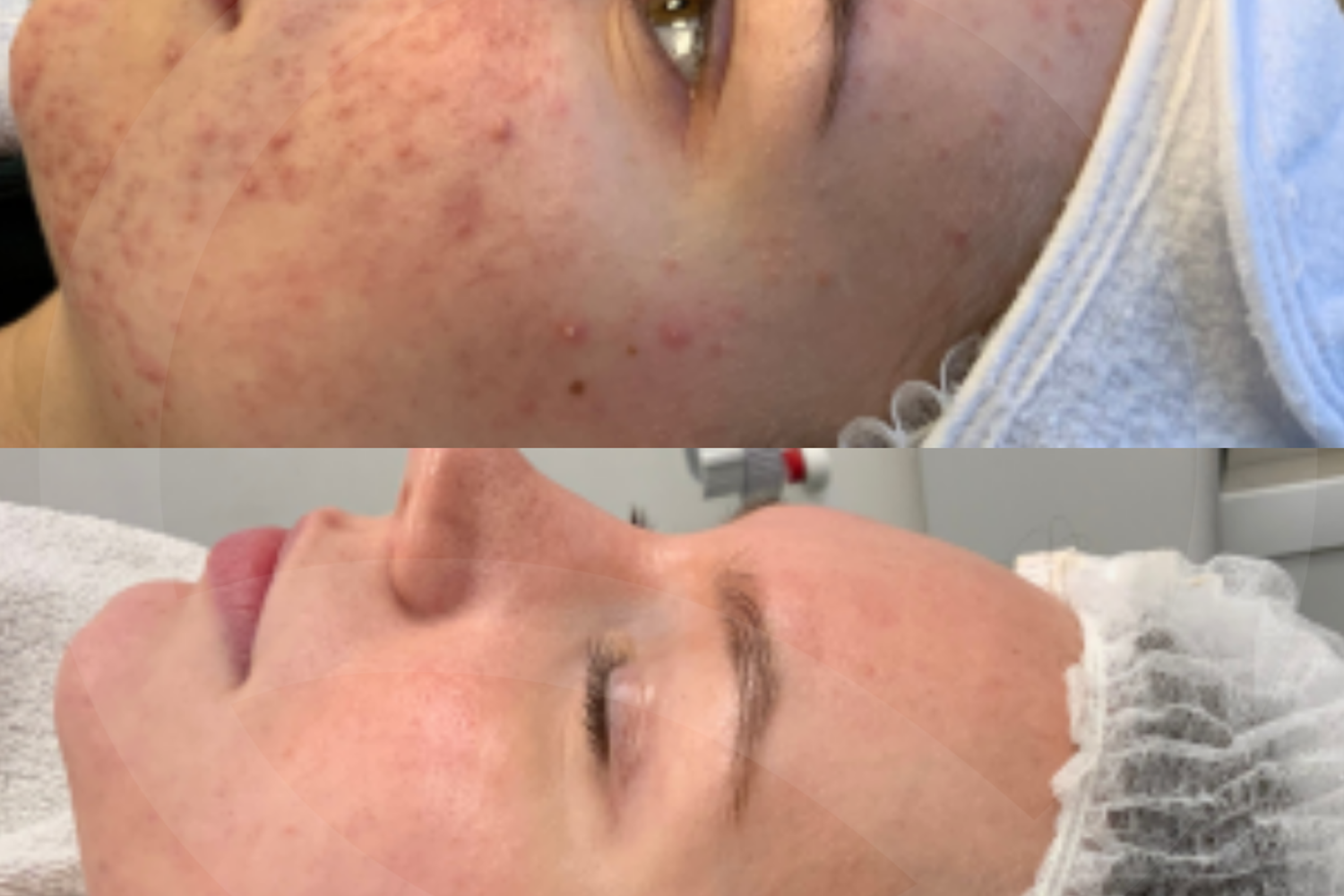 Resultat Avant Après Acné