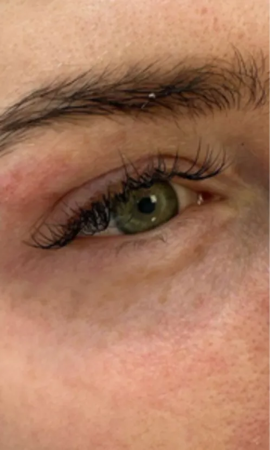 Total Eye Result 4 After