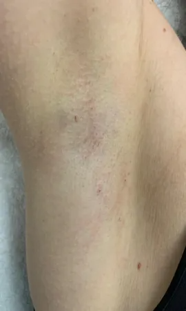 resultat epilation laser aiselles