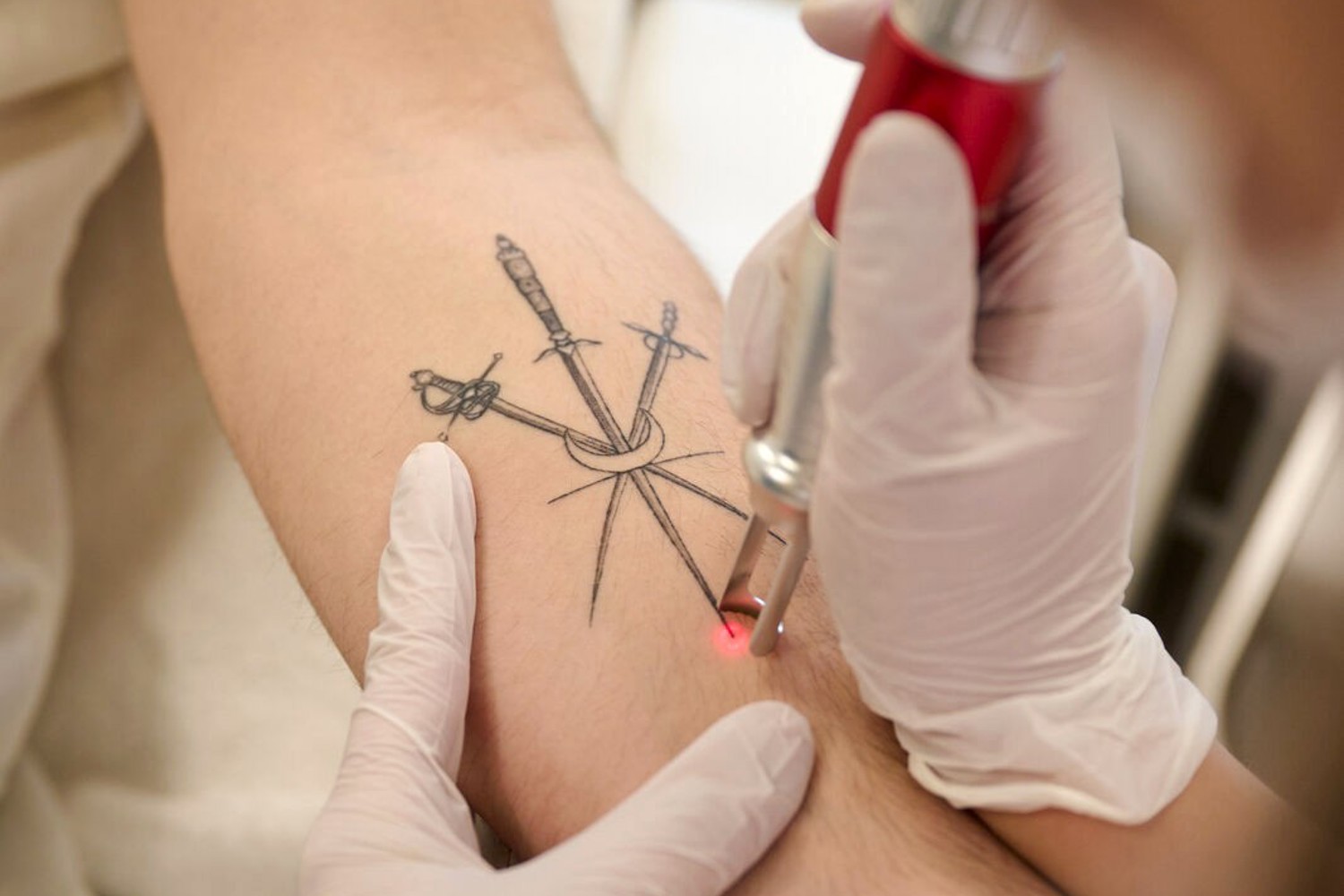 Snel Tattoo Verwijderen