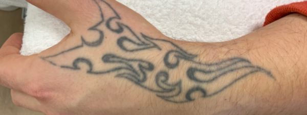 Resultaat Tattoo Verwijderen Voor