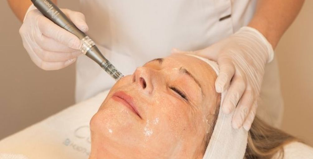 Een vrouw met een ontspannen uitstraling die microneedling ondergaat