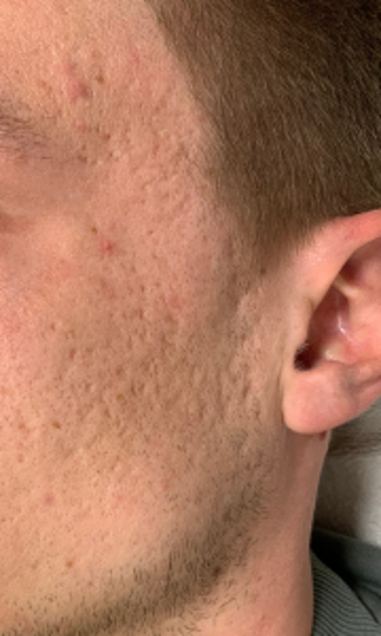 Huid met acnelittekens vóór de behandeling bij Cosmetique Totale