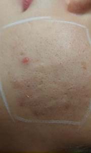 Résultat Cicatrices D'acne 2