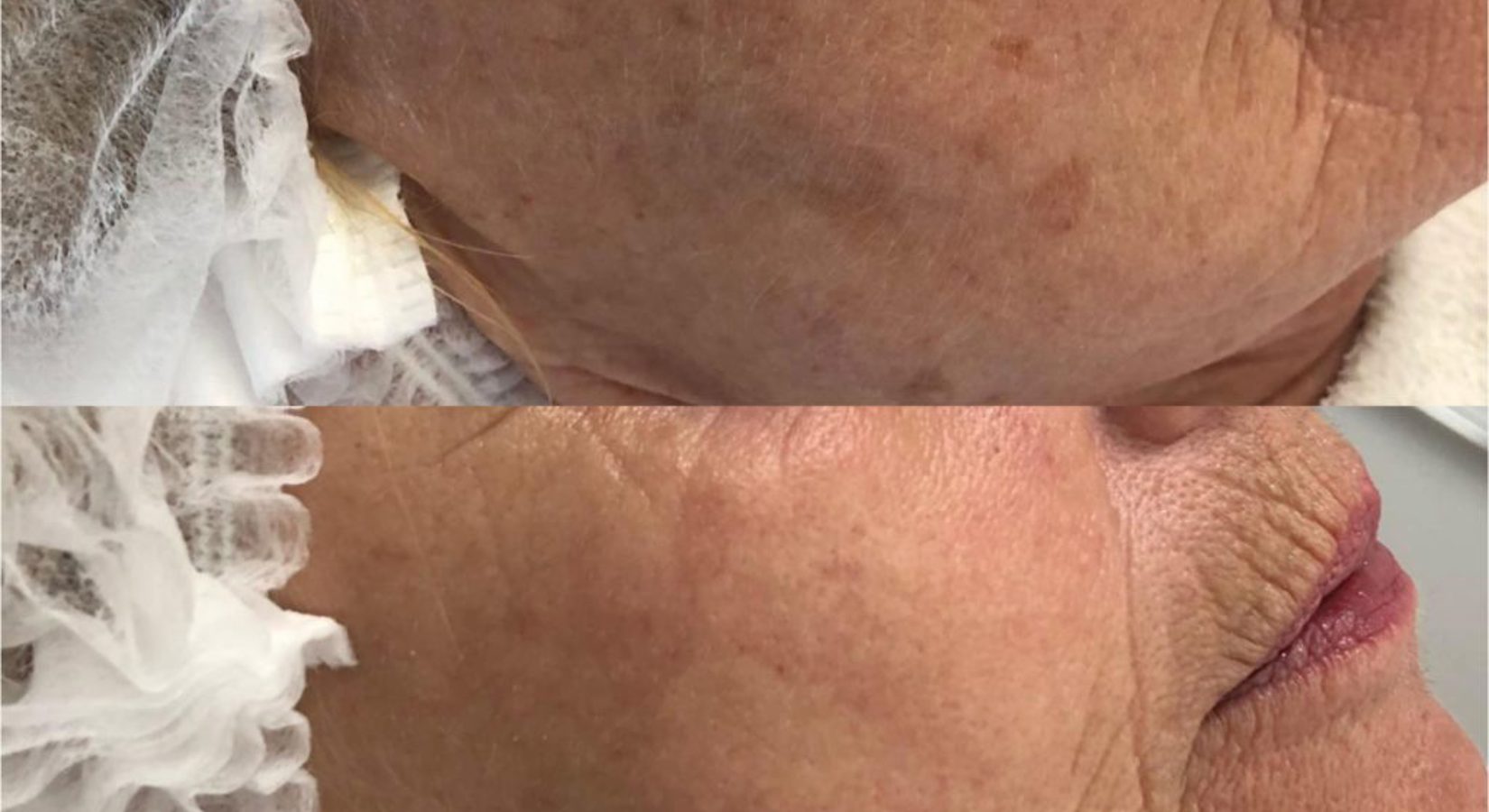 Header Huidschade Door De Zon