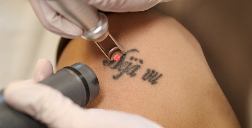 Spijt Van Je Tatoeage Wat Nu (1)
