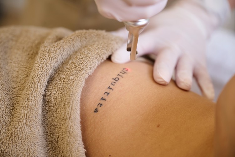Tattoo Laseren Zwolle
