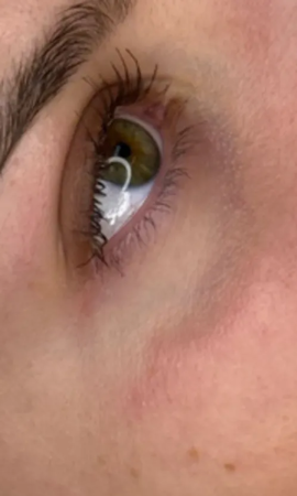 Total Eye Result 3 After