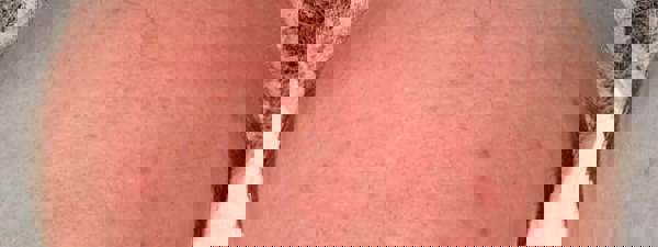 Ergebnis Nach 4 Behandlungen