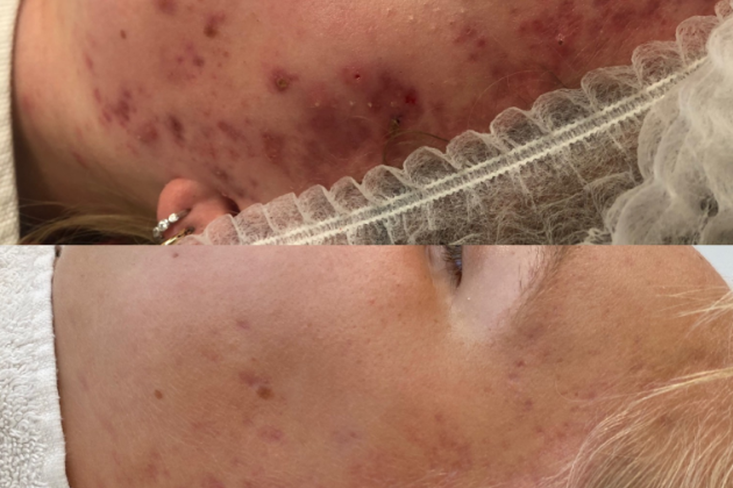Acne Behandeling Cosmetique Totale