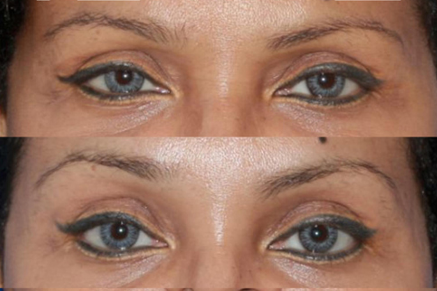 Resultats Lifting Sourcil Injections