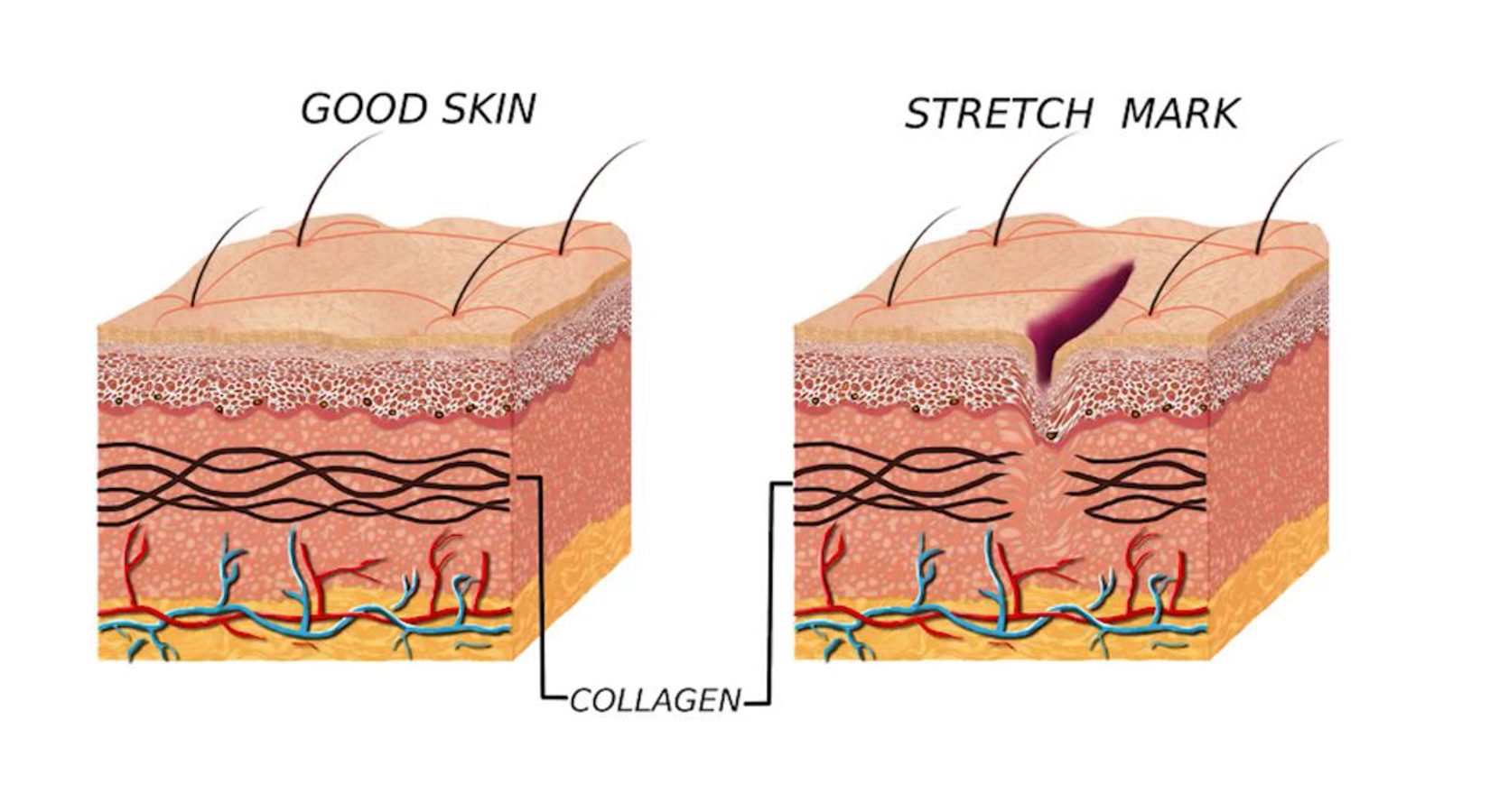 Striae Ervaring Cosmetique Totale