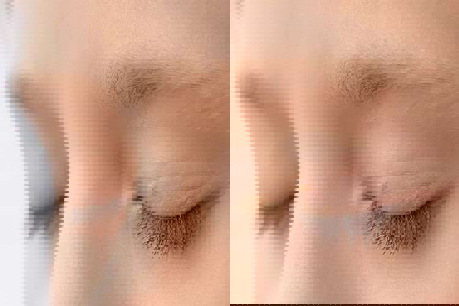 ACROCHORDONS ET VERRUES DE VIEILLESSE (1)