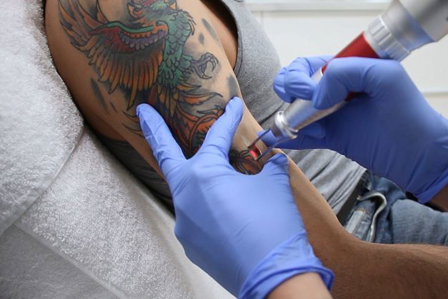 Gekleurde Tatoeage Verwijderen