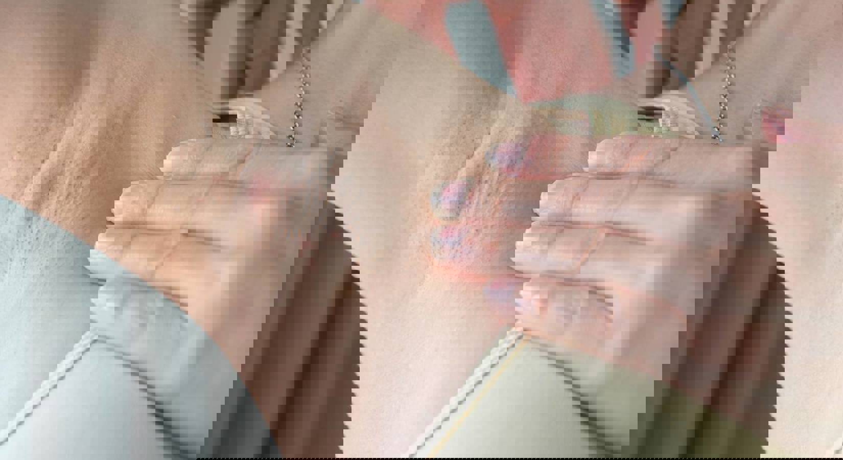 Overmatig Zweten Hyperhidrose