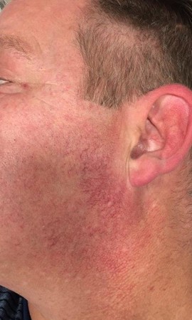 Traitement Couperose 22