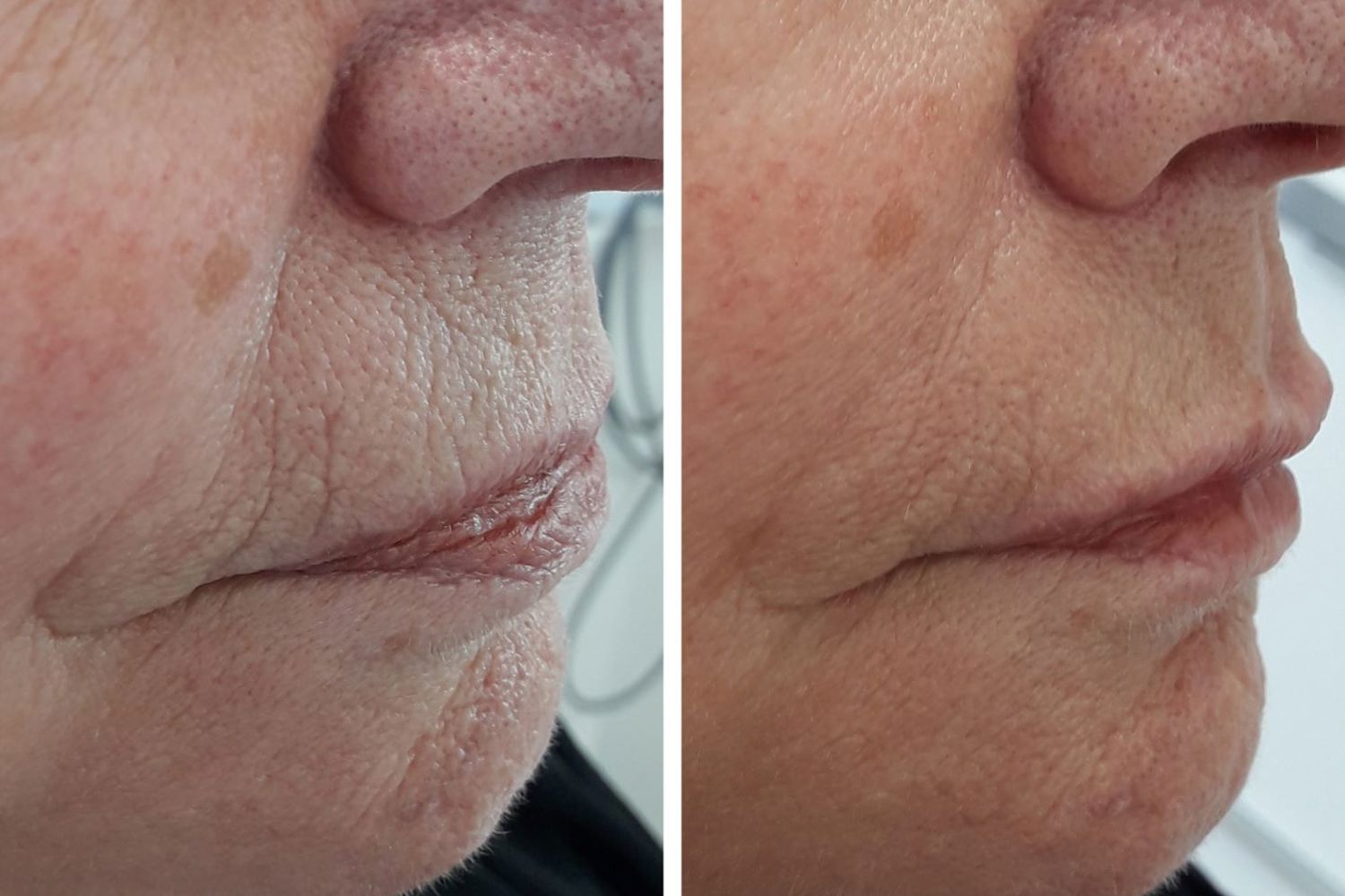 Voici ce que fumer fait votre peau Voici ce que fumer fait votre peau