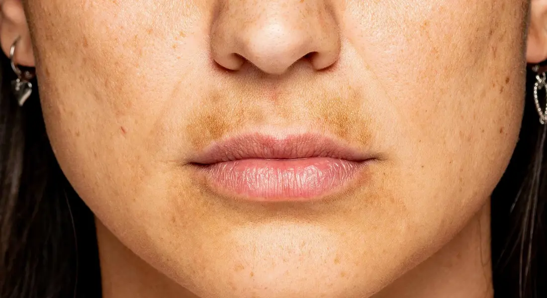 Melasma