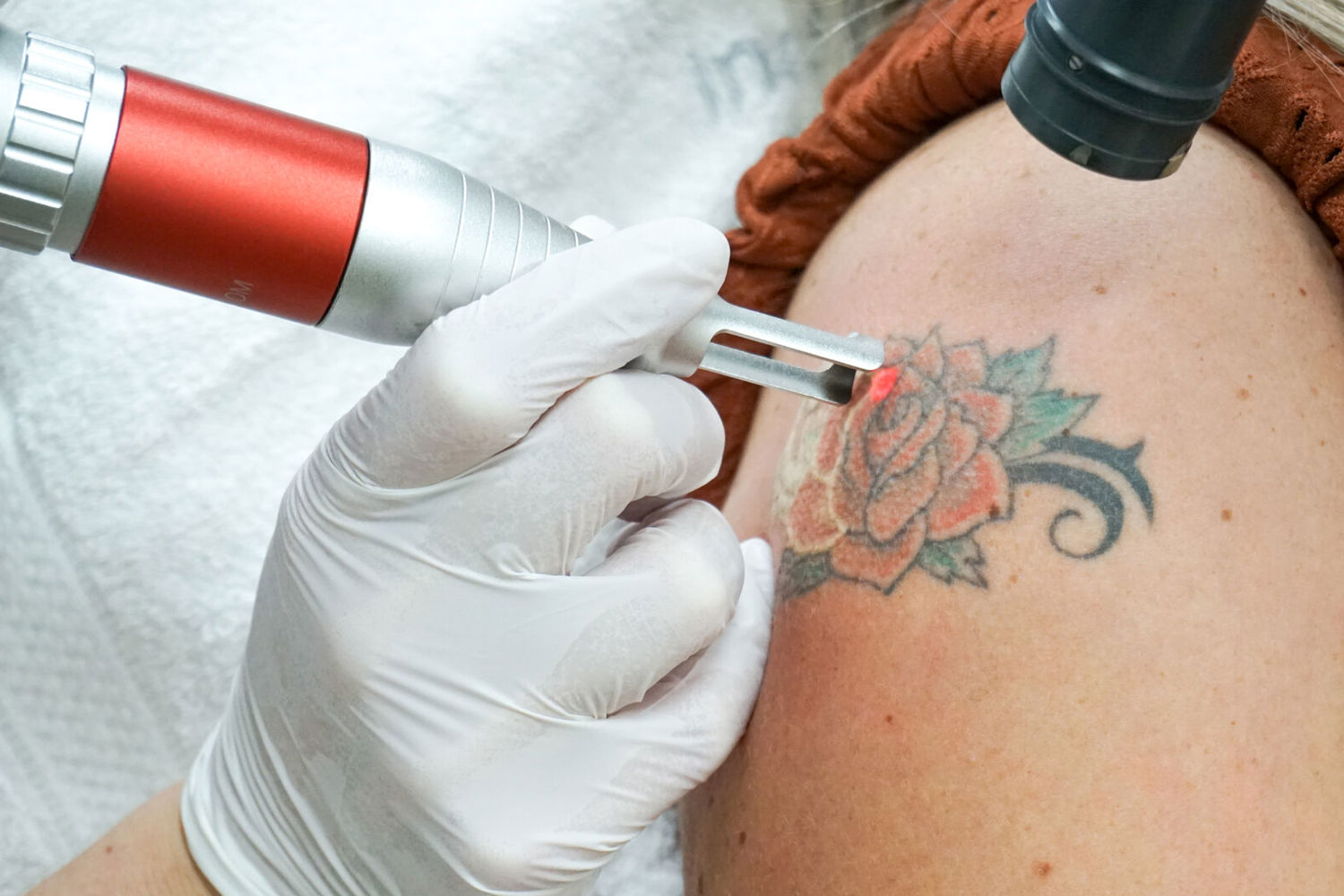 Tattoo laseren bij Cosmetique Totale