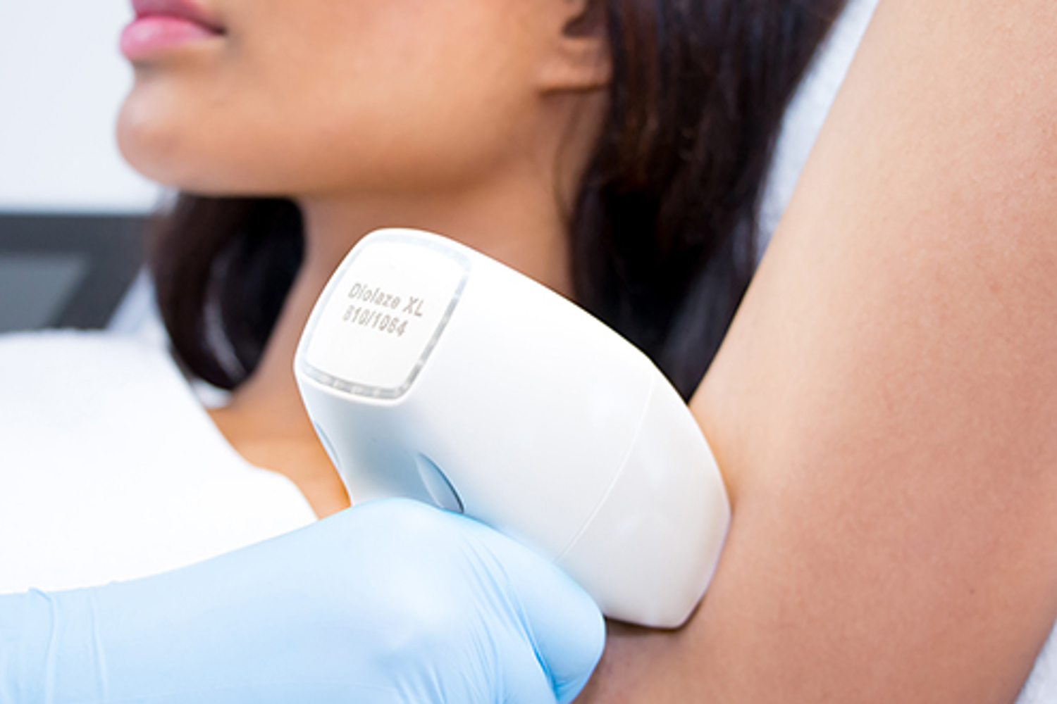 Ndyag Laser Donkere Huid (1)