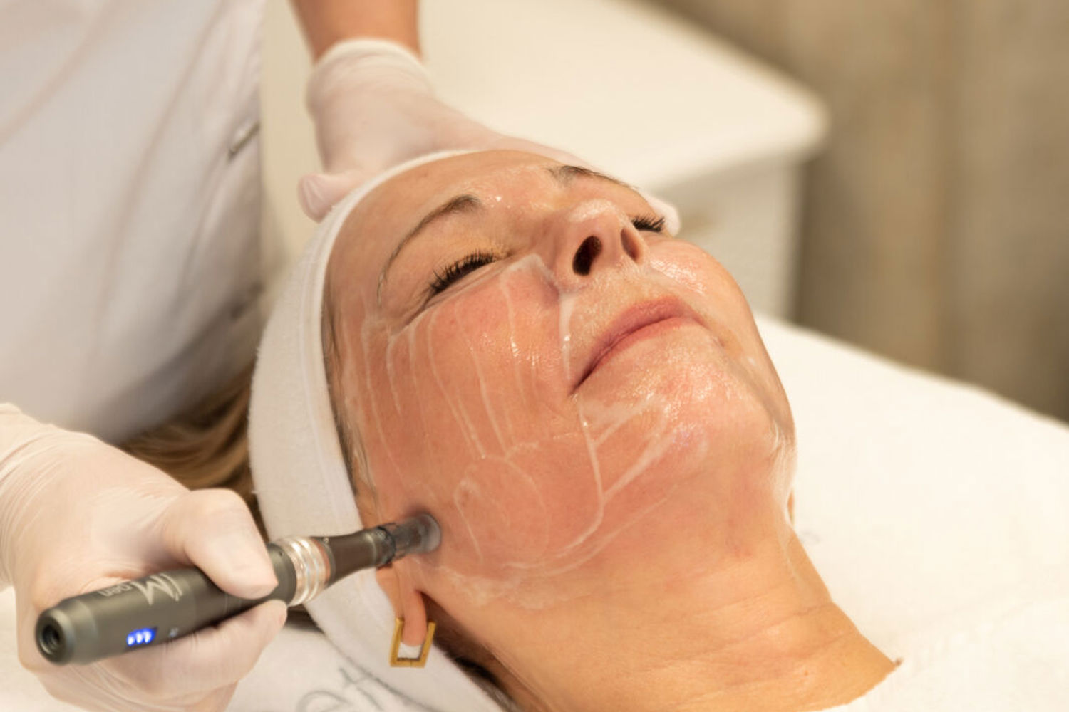 Is Microneedling Iets Voor Mij