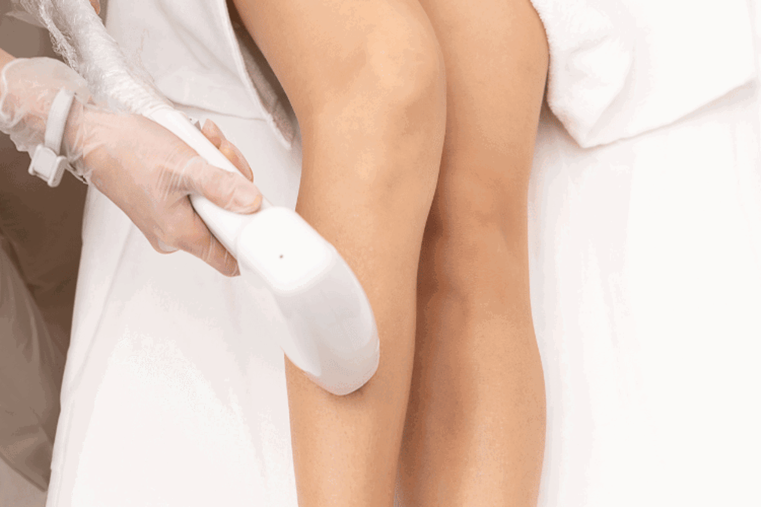 epilation laser sopk
