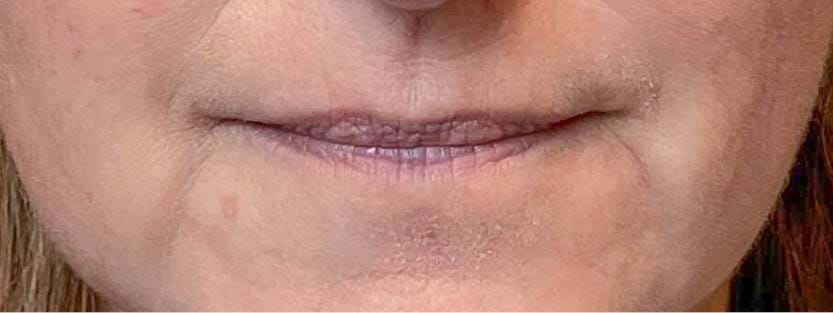 Lipfillers 4 (1)