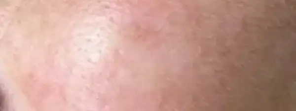 Couperose Laseren Resultaat