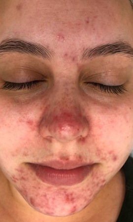 Traitement Rosasée 2