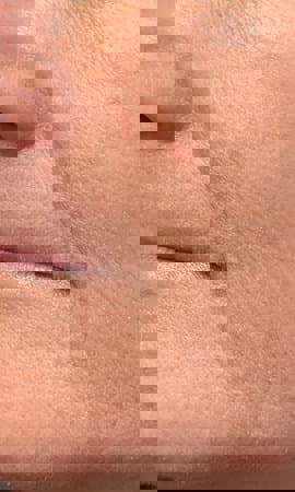 Ergebnis Nach Einer Laserbehandlung