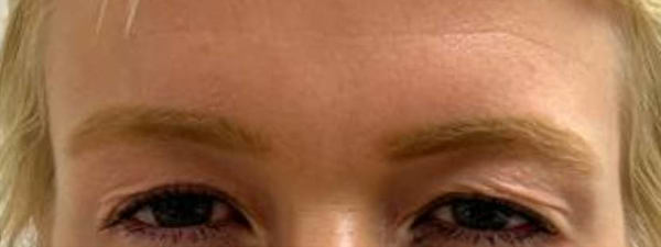 Botox Fronsrimpel2